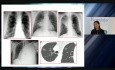 Postępowanie diagnostyczne z pacjentem z podejrzeniem raka płuca