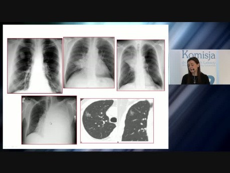 Postępowanie diagnostyczne z pacjentem z podejrzeniem raka płuca