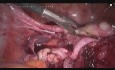 SLH - uwolnienie zrostów wewnątrzotrzewnowych, laparoskopowe usunięcie trzony macicy z jajowodami