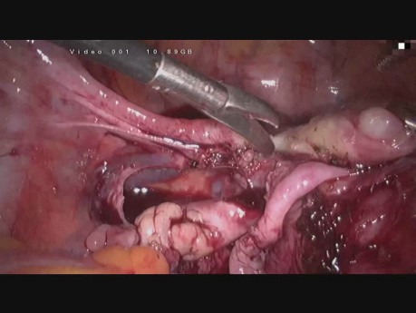 SLH - uwolnienie zrostów wewnątrzotrzewnowych, laparoskopowe usunięcie trzony macicy z jajowodami