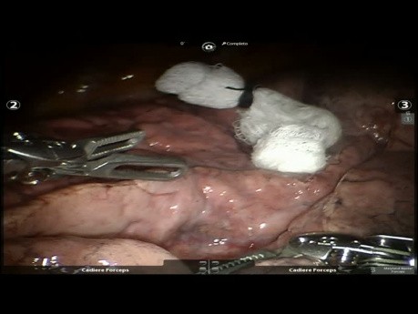 Lobektomia górna lewostronna z użyciem robota z powodu raka płuca