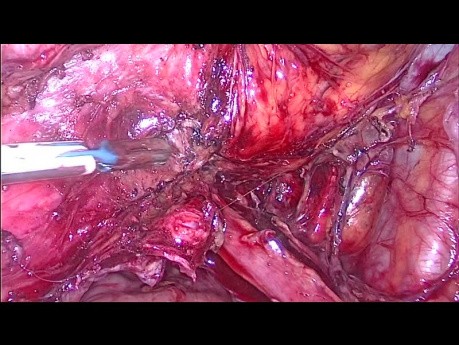Anatomia więzadła pęcherzowo-macicznego