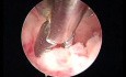 Biopsja histeroskopowa i waporyzacja endometrium elektrodą Spring Versapoint