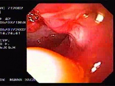 Choroba Leśniowskiego - Crohna - endoskopia (18 z 28)