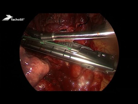 Resekcja środkowego płata płuca metodą VATS z zastosowaniem matrycy TachoSil