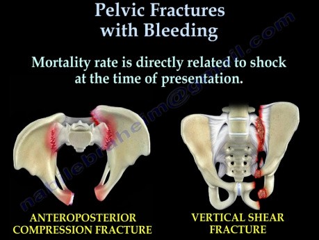 Złamania miednicy z krwawieniem