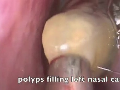 Funkcjonalna endoskopowa operacja zatok - grzybicze zapalenie błony śluzowej jamy nosowej i zatok przynosowych