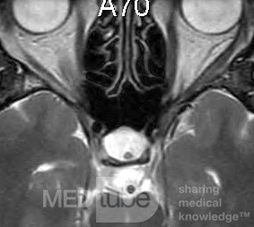 Torbiel Thornwaldta MRI