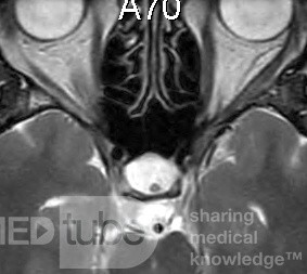 Torbiel Thornwaldta MRI