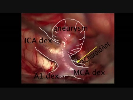 Klipsowanie tętniaków z wykorzystaniem wideoangiografii ICG - kompilacja zabiegów mikroneurochirurgicznych