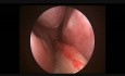 Rak nosogardła i wysiękowe zapalenie ucha środkowego
