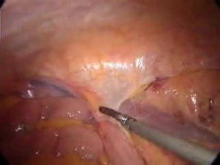 Hemikolektomia prawostronna metodą laparoskopową