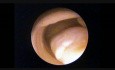 Histeroskopia - biopsja polipa endometrialnego