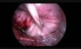 Laparoskopoa operacja usunięcia mięśniaka więzadła szerokiego macicy
