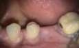 Zmiana okołowierzchołkowa przy filarze protetycznym zęba 35