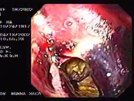 Wrzodziejący gruczolakorak dna żołądka z krwawieniem