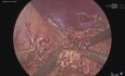 Laparoscopic Lateral Pancreatico-jejunostomy (Modified Puestow Procedure) for Chronic Pancreatitis 