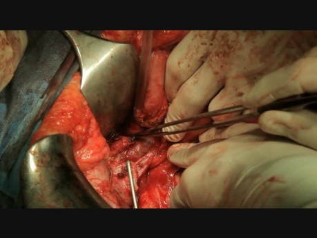 Pankreatoduodenektomia metodą Traverso