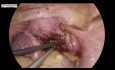 Laparoskopowa miomektomia w przypadku mięśniaka tylnej ściany macicy z towarzyszącą endometriozą. 