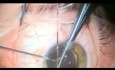 Usunięcie zmętniałej soczewki sztucznej z oka po witrektomii tylnej