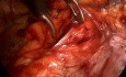 TEP – plastyka przepukliny pachwinowej w 15 minut | Krok po kroku (Total Extraperitoneal Repair)