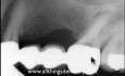 Przypadek Endodontyczny - Powtórne leczenie kanałowe powtórnego leczenia kanałowego?