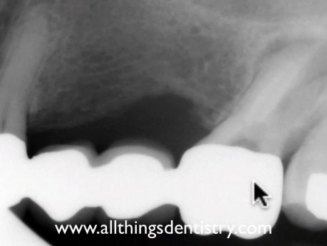 Przypadek Endodontyczny - Powtórne leczenie kanałowe powtórnego leczenia kanałowego?
