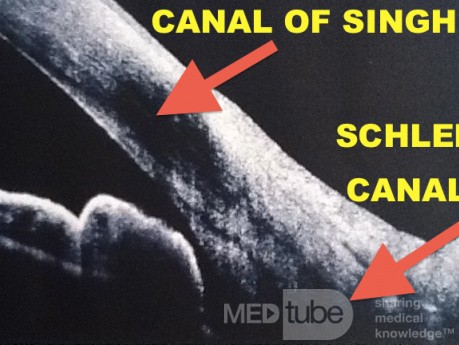 Kanał Schlemma a kanał nosowo-łzowy - połączenie
