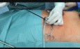 Laparoskopowa hernioplastyka metodą Totally Extraperitoneal Repair - spojrzenie urologa