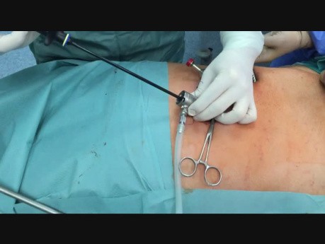 Laparoskopowa hernioplastyka metodą Totally Extraperitoneal Repair - spojrzenie urologa