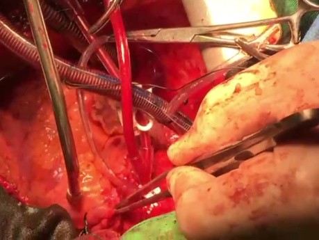 Sekwencyjna transplantacja serca - kluczowe wskazówki techniczne