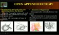 Otwarta appendektomia 