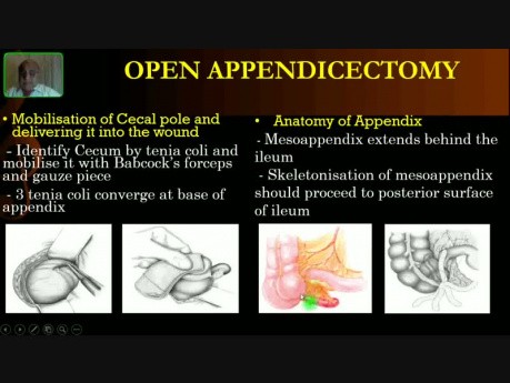 Otwarta appendektomia 