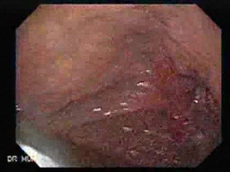 Refluksowe zapalenie przełyku i rak gruczołowy jamy odźwiernikowej (1 z 3)