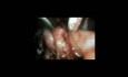 Trudny laparoskopowy zabieg cholecystektomii