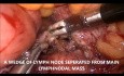 Laparoskopowa biopsja węzłów chłonnych okołoaortalnych