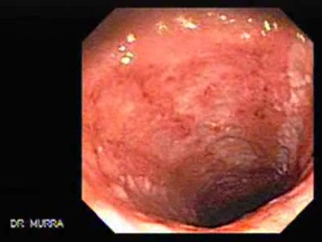 Badanie endoskopowe wrzodziejącego zapalenia jelita grubego (2 z 3)