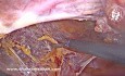 Brak lewostronnej siatki anatomicznej? Odwrócona siatka prawostronna jako śródoperacyjne rozwiązanie ratunkowe