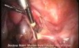 Leczenie radykalne ciąży ektopowej laparoskopowo