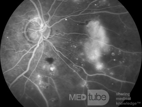 Proliferacyjna retinopatia cukrzycowa w angiografii fluoresceinowej.