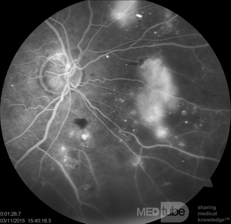 Proliferacyjna retinopatia cukrzycowa w angiografii fluoresceinowej.