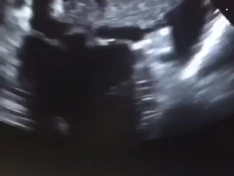 Ogromna skrzeplina w lewym przedsionku serca