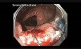 Okrężnica poprzeczna - endoskopowa resekcja śluzówkowa olbrzymiego guza