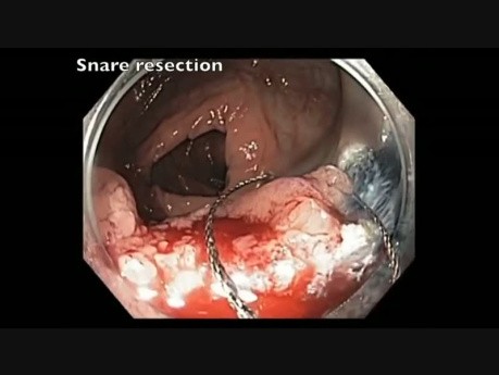 Okrężnica poprzeczna - endoskopowa resekcja śluzówkowa olbrzymiego guza