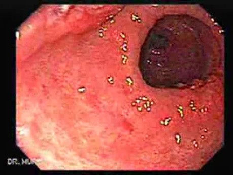 Rak gruczołowy jamy odźwiernikowej i wcięcia kątowego żołądka (2 z 3)