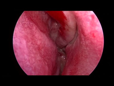 polipo antrocoanal