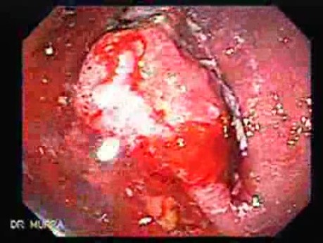 Rak żołądka we wczesnym stadium - endoskopia (1 z 21)