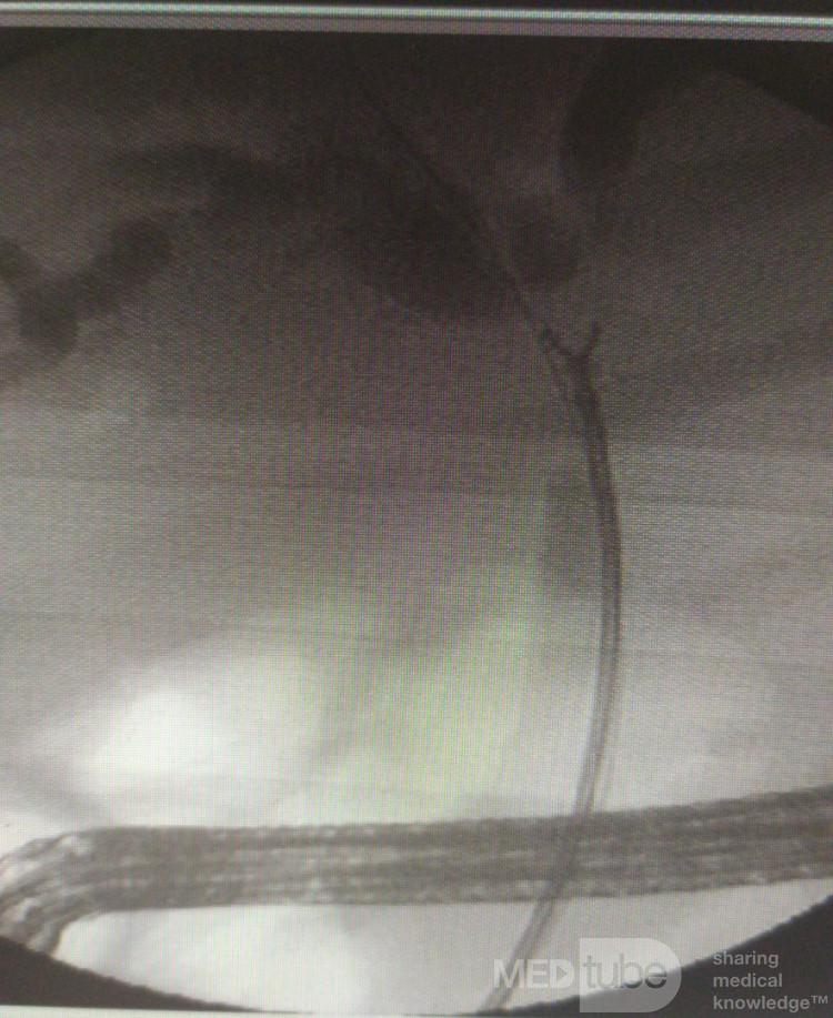 Biopsja kleszczykowa guza Klatskina pod kontrolą fluoroskopii