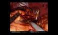 Robotyczna resekcja żołądka, splenektomia i dystalna pankreatektomia z powodu guza żołądka