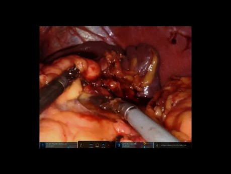 Robotyczna resekcja żołądka, splenektomia i dystalna pankreatektomia z powodu guza żołądka